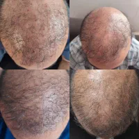 مزوتراپی موی سر