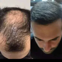 کلینک کاشت مو ریش ابروبلفارواقساط بدلخواه مشتری