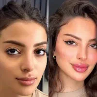ژل و بوتاکس وپی آر پی وانواع نخ