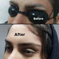 لیزرتتوابرو،لیزرهالیوودی کیوسوئیچ|خدمات آرایشگری و زیبایی|بروجرد, |دیوار