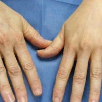 تزریق چربی جوانساز|خدمات آرایشگری و زیبایی|رفسنجان, |دیوار