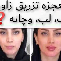 ژل لب روسی،بوتاکس بالیوودی، فیلرزیر چشم،لیفت شقیقه|خدمات آرایشگری و زیبایی|مشهد, سرافرازان|دیوار