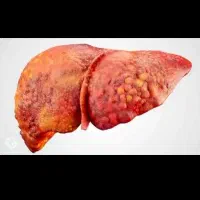 بهبود کبد چرب