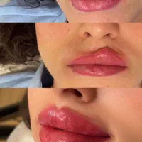 تزریق ژل فیلر بوتاکس مزو و لیزر در کلینیک زیبایی|خدمات آرایشگری و زیبایی|رباطکریم, رباطکریم|دیوار