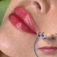 تزریق ژل لب .بوتاکس.لیفت نخ . درمان لک|خدمات آرایشگری و زیبایی|درگهان, |دیوار
