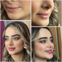 تزریق فیلر لب با متدهای ترند اینستا - دکتر واحدی|خدمات آرایشگری و زیبایی|قزوین, |دیوار