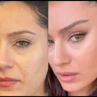 زیبایی لیفت بلفارو فرم بینی بوتاکس نخ ابروزاویه ژل|خدمات آرایشگری و زیبایی|اصفهان, بهارستان|دیوار