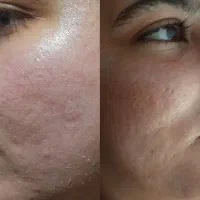 آفر ویژه لکبرداری صورت بانوان