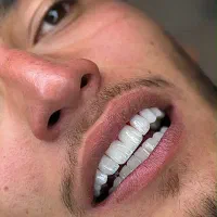 کامپوزیت دندان با متریال درجه‌یک و ۵۰٪ تخفیف