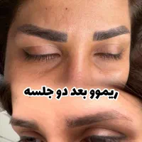 لیزر پاک کردن تتو تاتو کیوسوییچ رفع تتو ابرو و بدن