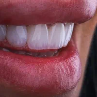 دندانپزشکی اقساطی با برترین مواد/کامپوزیت/ترمیم