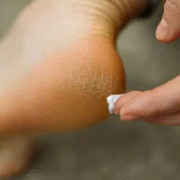 درمان قطعی ترک پا|آرایشی، بهداشتی، درمانی|شادگان, |دیوار