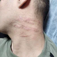 لیزر و رفع رد بخیه و اسکار|خدمات زیبایی و سلامت|مشهد, احمدآباد|دیوار