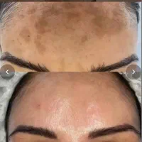 فیشیال و آلگاپیل و خالبرداری و هایفرکوئنسی|خدمات آرایشگری و زیبایی|شیراز, شریف‌آباد|دیوار