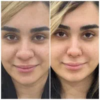لیفت بینی بدون جراحی