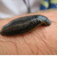 سلام حجامت زالودرمانی بادکش