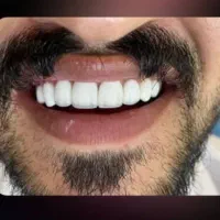 دندانپزشکی کامپوزیت با آفر ویژه تا ده روز اینده|خدمات آرایشگری و زیبایی|ارومیه, |دیوار