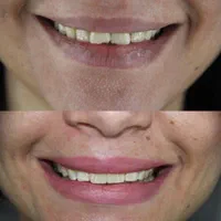 دندانپزشکی ونیر کامپوزیت و لمینت با شرایط پرداخت|خدمات آرایشگری و زیبایی|اصفهان, احمدآباد|دیوار