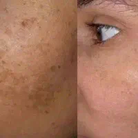 برای درمان لک هیچوقت دیرنیس
