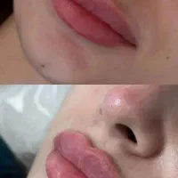 ژل و بوتاکس|خدمات آرایشگری و زیبایی|مشهد, ایثار|دیوار