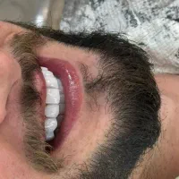 کامپوزیت فکی ۸ میلیون با ضمانت ده ساله(تهران)