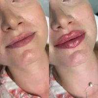 خدمات ژل و بوتاکس