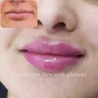 خدمات تخصصی ژل.بوتاکس.سابسیژن‌.مزونیدلینگ.خال