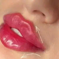 آموزش تزریق ژل لب هالیوودی
