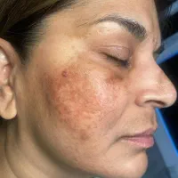 نیازمند مدل جهت رفع کک ومک بدون عکاسی و فیلمبرداری|خدمات زیبایی و سلامت|کرج, گلشهر|دیوار