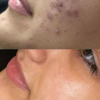 آموزش فیشیال پاکسازی پوست تخفیف بلک فرایدی|خدمات آموزشی|کرمانشاه, |دیوار