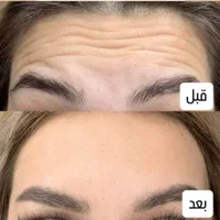 تزریق ژل لب بوتاکس مزوتراپی فیلر صورت در تهران|خدمات آرایشگری و زیبایی|تهران, فلسطین (میدان انقلاب)|دیوار