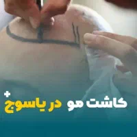 اجاره لاین کاشت مو