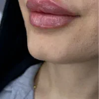 ژل بوتاکس ژل لب فیلرزیر چشم مزوتراپی مزوژل|خدمات آرایشگری و زیبایی|شیراز, کاراندیش|دیوار
