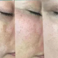 پی ارپی صورت و مو و دست بوتاکس فول فیس مصپورت
