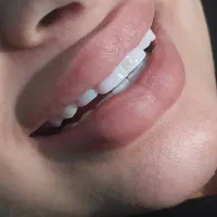 کامپوزیت دندان
