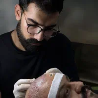 کاشت موی فول تراکم در تبریز