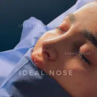 جشنوار عمل زیبایی بینی با تخفیف ویژه