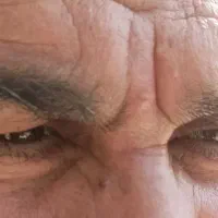 زگیل خال گوشتی و مخچه و...|خدمات آرایشگری و زیبایی|سرپل ذهاب, |دیوار