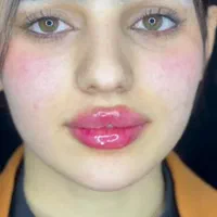 تزریق ژل لب بوتاکس مزوتراپی فیلر صورت در تهران|خدمات آرایشگری و زیبایی|تهران, فلسطین (میدان انقلاب)|دیوار