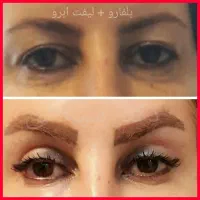 لیفت جراحی صورت شقیقه پیشانی سینه ماموپلاستی پلک