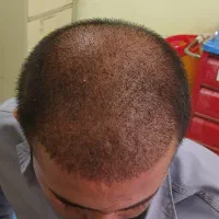 کاشت موی طبیعی فول تراکم|خدمات آرایشگری و زیبایی|ساری, |دیوار