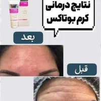 کرم بوتاکس|آرایشی، بهداشتی، درمانی|مراغه, |دیوار
