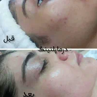 کربن تراپی صورت و بدن|خدمات آرایشگری و زیبایی|فردیس, فردیس|دیوار