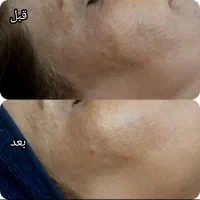 فیشال پاکسازی پوست آقایان فیشیال تخصصی کلینیک قم|خدمات آرایشگری و زیبایی|قم, دورشهر|دیوار