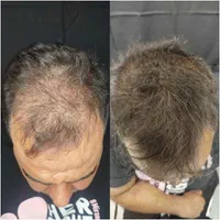 میکرو اسکالپ.اولین مرکز تخصصی میکرو اسکالپ در کرج|خدمات آرایشگری و زیبایی|کرج, عظیمیه|دیوار