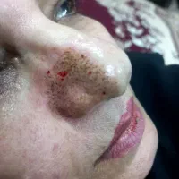 برداشتن خال و زگیل