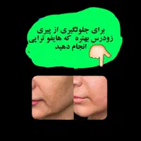 لیزر موهای زائد صورت وبدن،  جوانسازی پوست|خدمات آرایشگری و زیبایی|رفسنجان, |دیوار