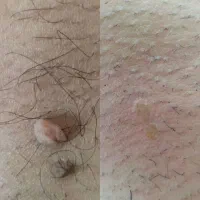 بهبود کامل زگیل و تبخال در همه جای بدن
