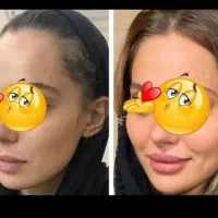 پر و سفید شدن صورت بت طب سنتی