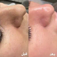 پاکسازی صورت با دستگاه و مواد کاملا گیاهی